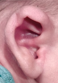 “Constircted ear” , Kornoutovité ucho